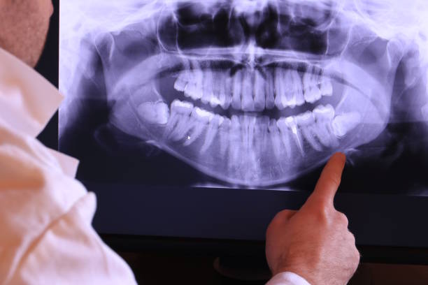Best Emergency Wisdom Tooth Extraction in Taylor Mill, KY